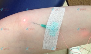 кodirovanie ot alkogolizma lazerom